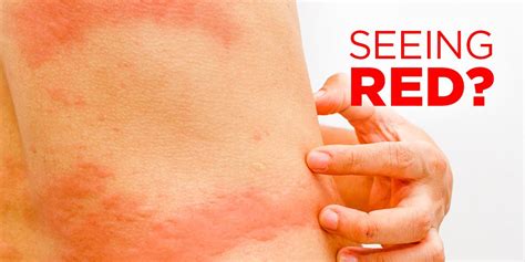 Rash is a symptom that causes the affected area to turn red and blotchy and swell. What's That Rash on Your Body? | Women's Health