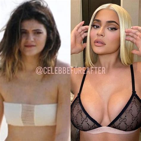 These Before And After Pics Of Kylie Jenner Are Insanedid She Have