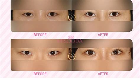 Why Korean Double Eyelid Surgery Guide Reviews Images Promotions