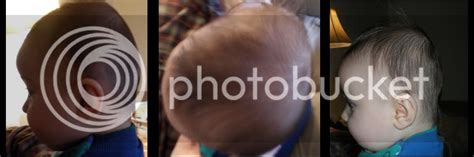 Why Is My Sons Head Like This Lumpy Bumpy Mishapen Picture Babygaga