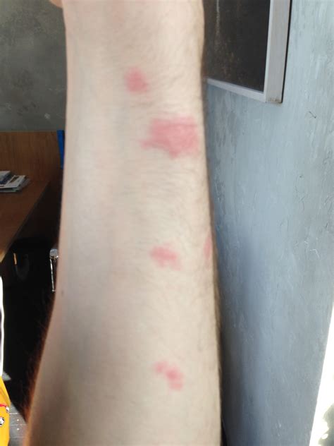Infected Bed Bug Bites