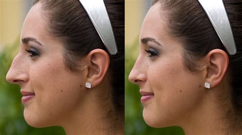 The Secret To Nose Reshaping Without Surgery Non Surgical Rhinoplasty