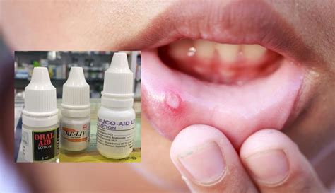 Senarai Ubat Rawat Ulser Mulut Yang Anda Boleh Beli Di Farmasi Agar