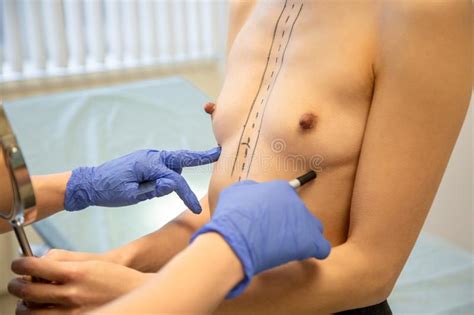 Plastic Surgery Closeup Of Naked Woman Body With Black Surgical Marks On Her Breast Stock Image