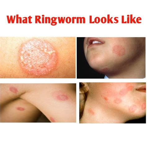 What Does Ringworm Look Like Pictured Public Health Sexiz Pix