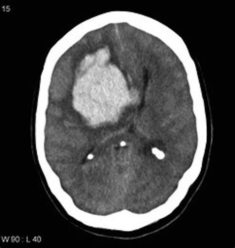 Axial Noncontrast Head Ct Scan Showing A Large Lobar Hemorrhage In The