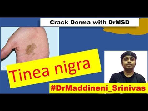 Tinea Nigra Black Mold Skin Infection Dematiceous Pigmented Fungus