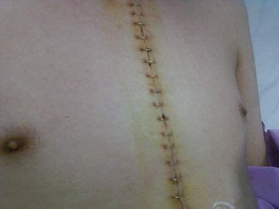 Open Heart Surgery Scars Different Types