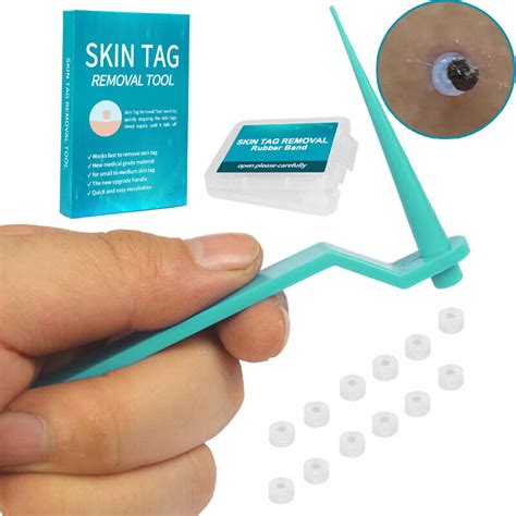 new micro skin tag remover rubber bands for tag remover wart remove ac the warehouse liquidation