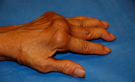 CODAES Artritis Reumatoide