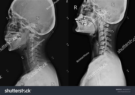 Xray Cervical Spine Lateral Views2 Views Foto Stok 1464265013