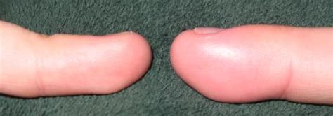 They function as filters, trapping viruses, bacteria and other. swollen - definition - What is