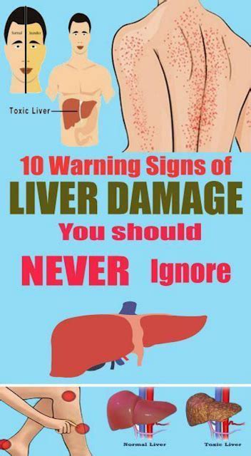 Warning Signs Of Liver Damage That You Should Never Ignore Liver Problems Liver Damage