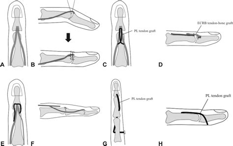Surgical Treatment For Chronic Tendon Mallet Injury