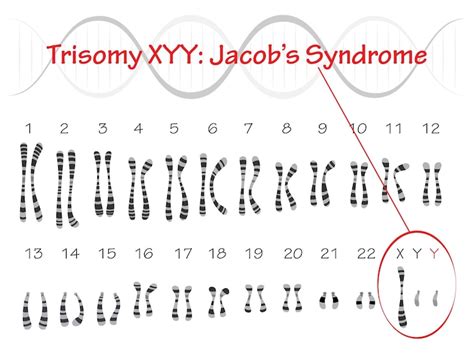 Premium Vector Jacobs Syndrome Karyotype