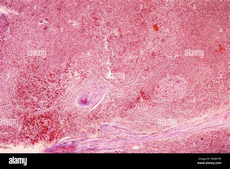 Amigdalitis Tejido Enfermo Bajo El Microscopio 100x Fotografía De Stock