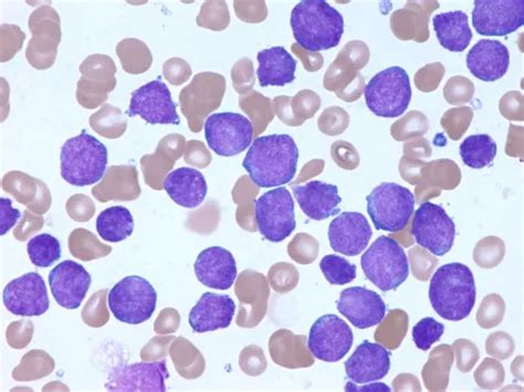 Acute Lymphoblastic Leukemia All In Children And Teens Together