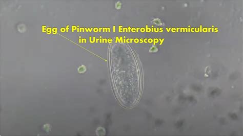 Egg Of Pinworm In Urine Microscopy Enterobius Vermicularis Youtube