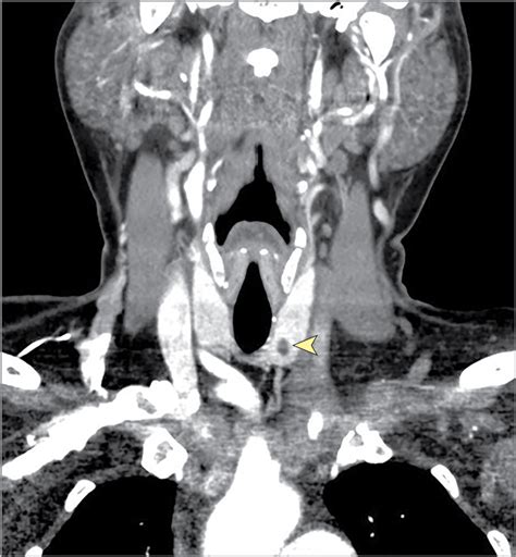 Risks And Harms Of Management Of Incidental Thyroid Nodules