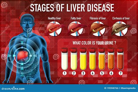 Stages Of Liver Disease Stock Vector Illustration Of Healthy 195948766