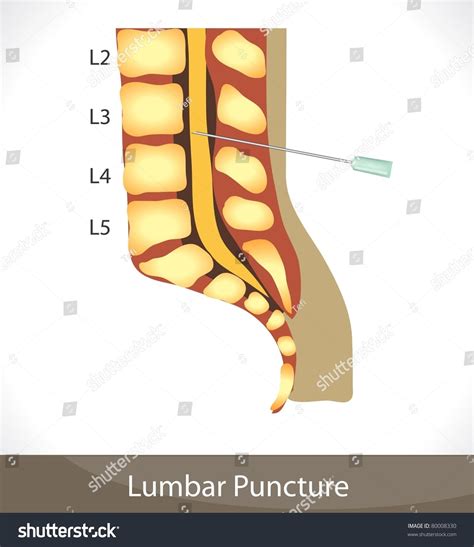Lumbar Puncture Detailed Diagram Of Lumbar Puncture