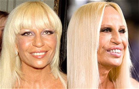 Donatella Versace Plastic Surgery Before And After Nose Job Facelift And Cheek Implants