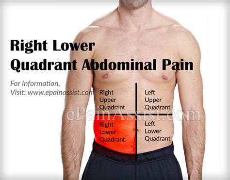 Right Higher Abdominal Rib Pain M Medical