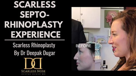 Scarless Septorhinoplasty Nose Job Experience Rhinoplasty With Dr Deepak Dugar Beverly Hills