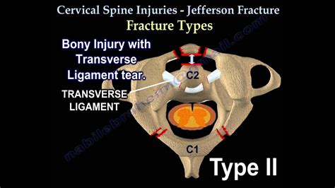 Cervical Spine Injuries Jefferson Fracture Everything You Need To