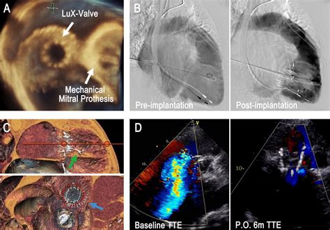 Transcatheter Tricuspid Valve Replacement In Patients With Severe