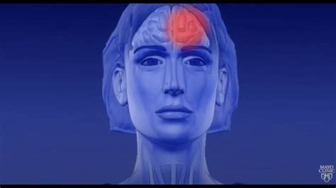 Learn About Migraine Aura Youtube