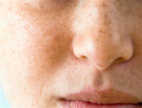Brown Spots On Face Skin Causes Raised Patches Pictures Get Rid
