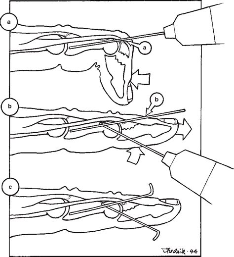 Figure 1 From Extension Block Pinning Of Mallet Fractures