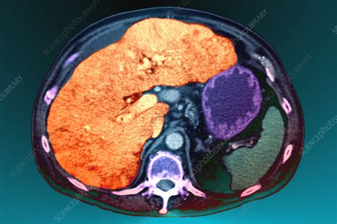 Enlarged Liver Due To Portal Hypertension Stock Image M1700396