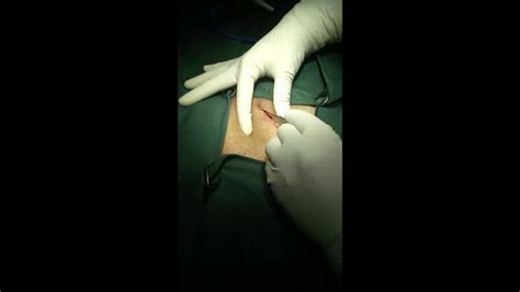 Inguinal Hernia Repair Under Nerve Block Using Lor Technique2 Youtube