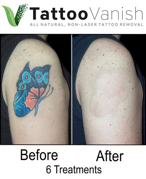 Share More Than 75 Big Tattoo Removal Before And After Ineteachers