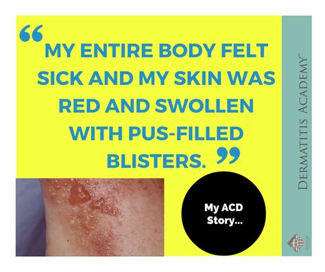 Propylene Glycol Struggle My Allergic Contact Dermatitis Story