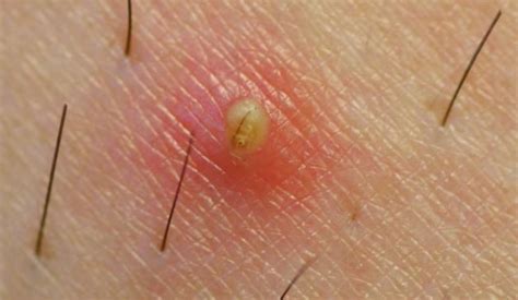 Usually, it causes intense itchiness and pain, especially when it gets infected. Deep Ingrown Hair, How to Remove on Neck, Bikini, Face ...