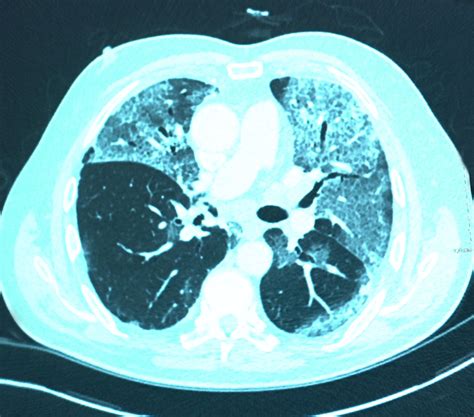 新型ウイルス重症者肺に損傷残る恐れ 英医師ら警告 BBCニュース