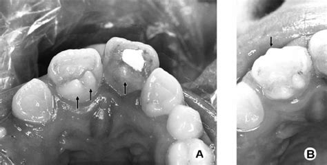 Intraoral Clinical Images A Talon Cusps On The Palatal Surfaces Of
