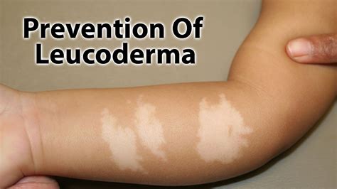 Prevention Of White Patchesleucoderma Youtube
