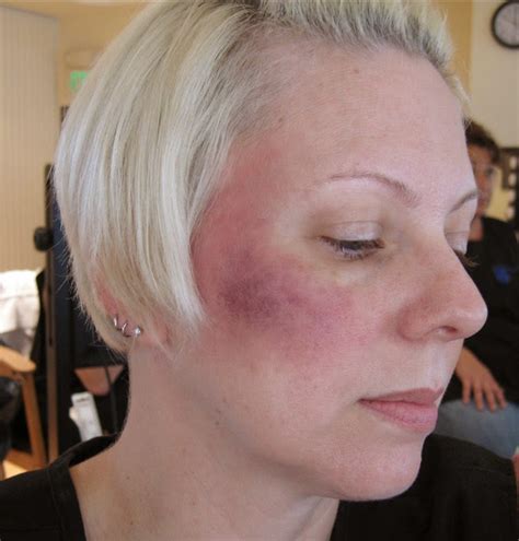 makeup bruises on face mugeek vidalondon