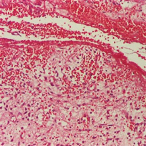 Hurley Stage Iii Suppurative Hidradenitis Affecting The Groin