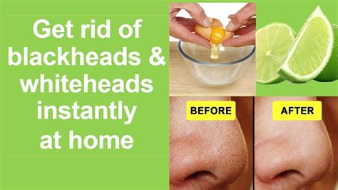 How To Remove Blackheads And Whiteheads From Nose And Chinpermanently