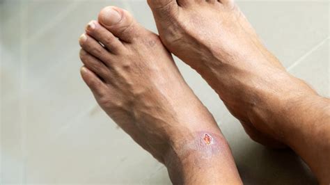 What Are Diabetic Foot Ulcers Causes Stages And Treatment Goodrx