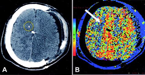Relationship Between Brain Tissue Oxygen Tension And Ct Perfusion