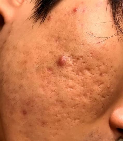 How Effective Is Intracel Rf For Deep Pitted Acne Scars Photo Human