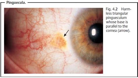 General Notes On The Causes Symptoms And Diagnosis Of Conjunctivitis