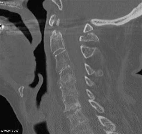 Rheumatoid Arthritis Of The Cervical Spine Radiology Case