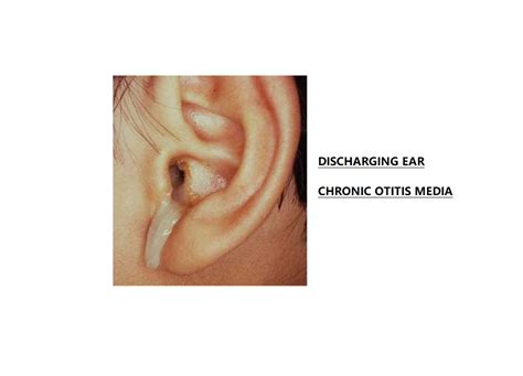 Do Your Ears Discharge What Is Chronic Otitis Media Dr Sharad Ent